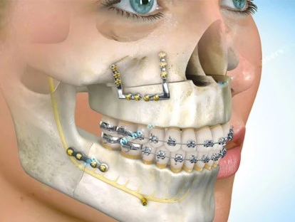 cirurgia de buco-maxilo-facial