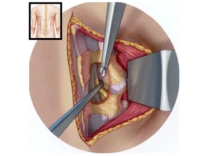 Cirurgia de microdiscectomia na coluna deve ser coberta pelo plano de saúde? Entenda!