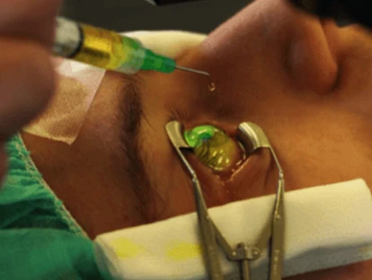 Plano de saúde é condenado a custear Crosslinking 