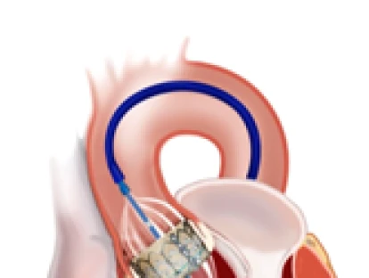 Implante da prótese Valvar Sapiens 3