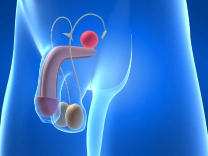 Tratamento cirúrgico de prostatectomia.