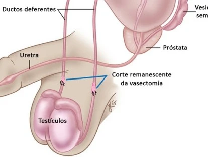Vasectomia