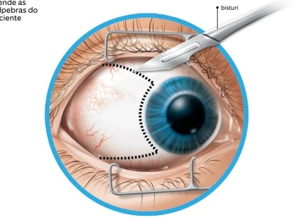 Cirurgia de Estrabismo: valor, riscos e cobertura pelo plano de saúde