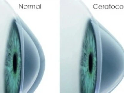  Cobertura de crosslink pelo plano de saúde