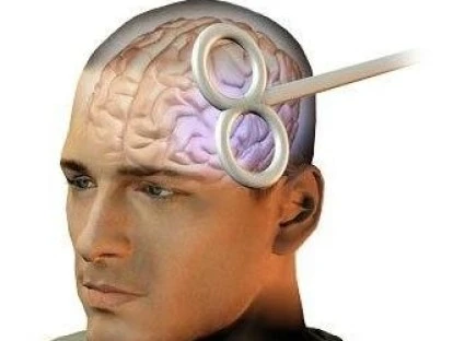 Estimulação Magnética Transcraniana