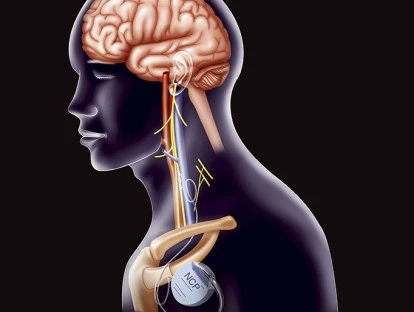 Plano de saúde deve custear cirurgia de epilepsia