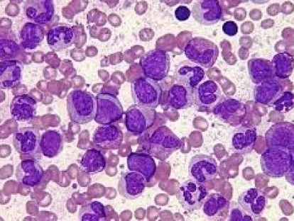 Bendamustine (Levact)