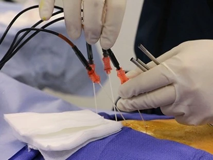 Rizotomia percutânea lombar