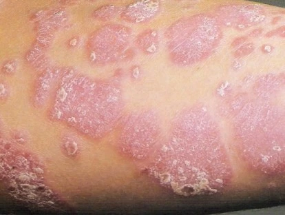 Stelara - Ustequinumabe