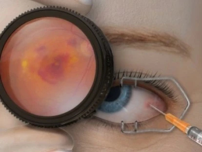 Ranibizumabe - Lucentis