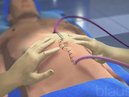 Cirurgia citorredutora: plano deverá reembolsar valores gastos pelo paciente