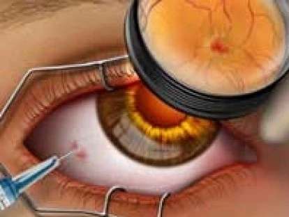 Lucentis - Degeneração macular