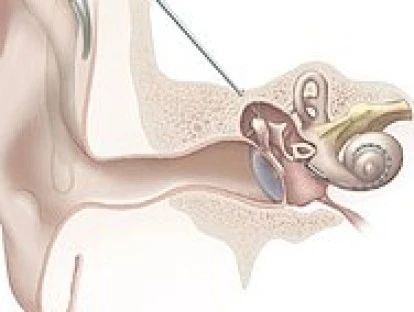 Implante coclear 