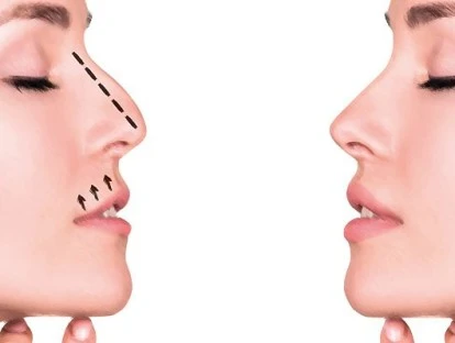 Erro médico em cirurgia de Rinoplastia: possibilidade de danos morais e estéticos