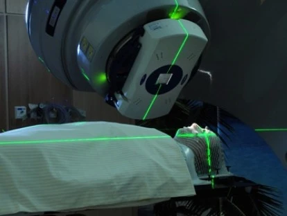 Radioterapia IMRT com modulação da intensidade de feixe