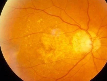 Planos de saúde devem pagar Eylia e Lucentis? Confira!