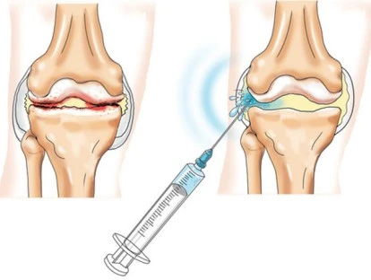 Como solicitar a cobertura do Synvisc-One (hilano G-F 20) pelo plano de saúde ou SUS