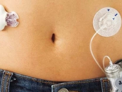 Plano de saúde deve custear bomba de insulina para tratar diabetes