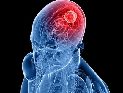 Monitoração Neurofisiológica Intraoperatória.