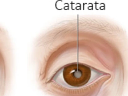 Cirurgia da Catarata