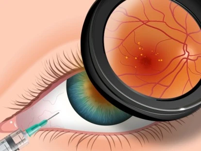 Medicamento Avastin (bevacizumabe)