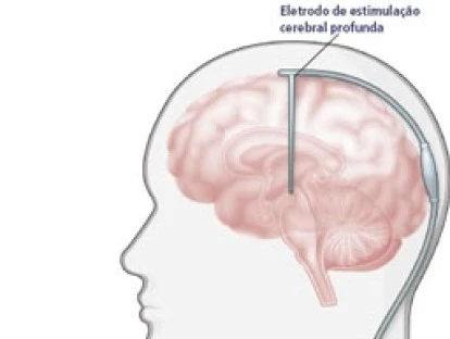 Implante de eletrodo cerebral profundo