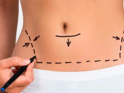 Retirada de excesso de pele pós bariátrica