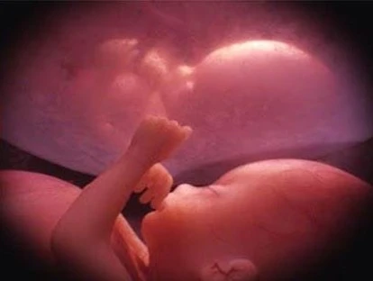 Erro médico com óbito fetal