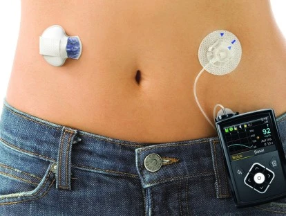 Bomba de infusão de insulina plano de saúde: como obter?