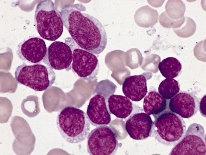 Medicamento Gazyva (obinutuzumabe)