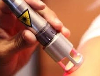 Laserterapia: plano de saúde deve custear tratamento moderno