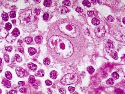 Brentuximabe deve ser fornecido pelo plano de saúde?