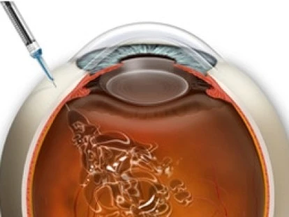 Lucentis - Plano de saúde tem obrigação de pagar