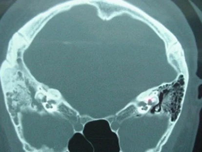 Mastoidite - erro médico