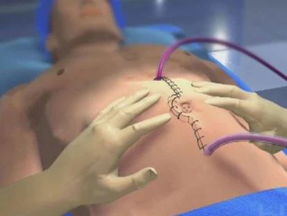 Quimioterapia intraperitoneal hipertérmica