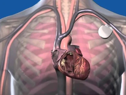 Implante de Marca-Passo