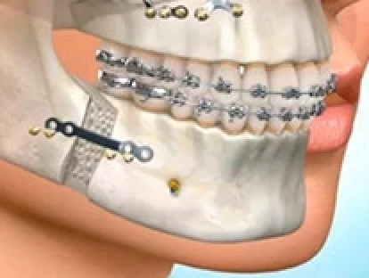 Plano de saúde é condenado a custear cirurgia e material cirúrgico 
