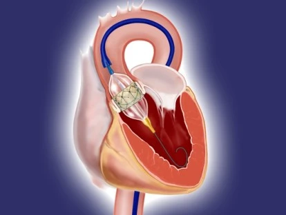 Cirurgia cardíaca via percutânea – TAVI.