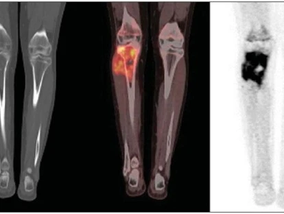 PET CT para metástase óssea pelo plano de saúde