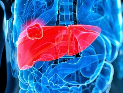 Radioembolização com Ytrium 90 deve ser paga pelo plano de saúde