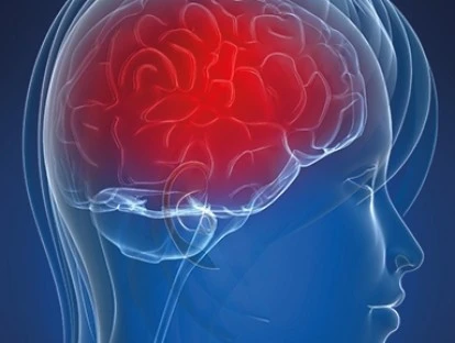 Neuromielite óptica - Rituximabe (Mabthera)