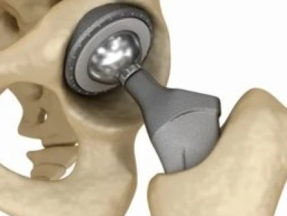 Artroplastia total de quadril deve ser custeada pelo plano de saúde