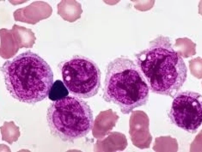 Justiça manda plano de saúde fornecer o Blinatumomab. Entenda!