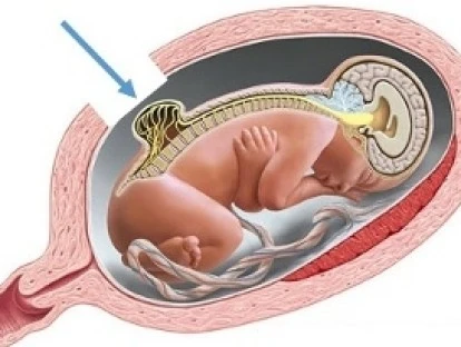 Cirurgia fetal para mielomeningocele sacral deve ser custeada pelo plano de saúde?