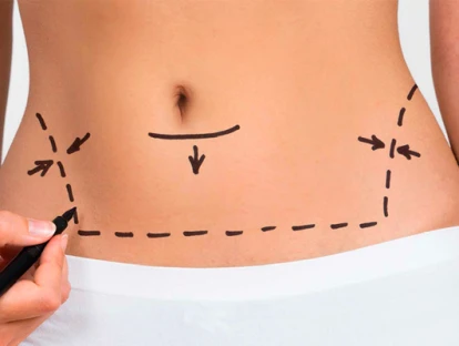 Plano de saúde deve custear cirurgia plástica reparadora pós-bariátrica
