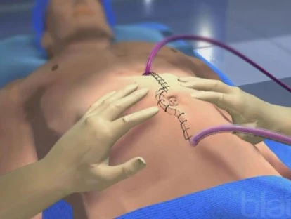 Quimioterapia intraperitoneal hipertérmica