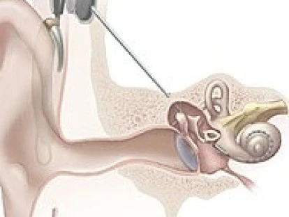 Implante coclear