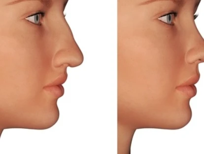 Cirurgia de rinoplastia 