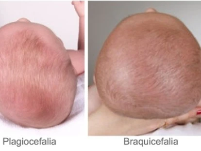 Tratamento de braquicefalia e plagiocefalia