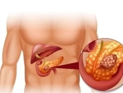 Pancreatite aguda: plano de saúde não pode exigir carência